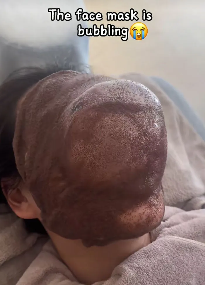 A brown bubble face mask expanding on a person's face representing beauty procedures fails
