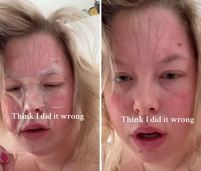 A woman with red lines on her face after a sheet beauty procedures fails