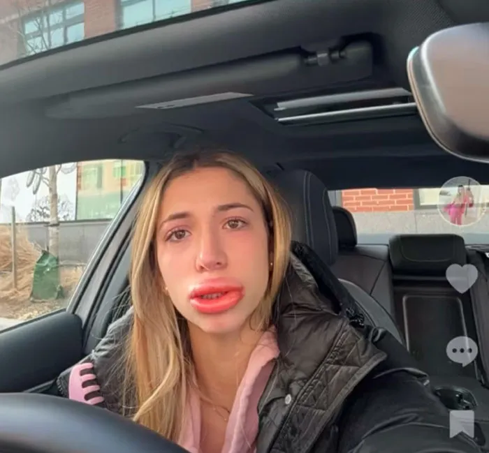 A woman sitting in a car showing swollen lips from beauty procedures fails