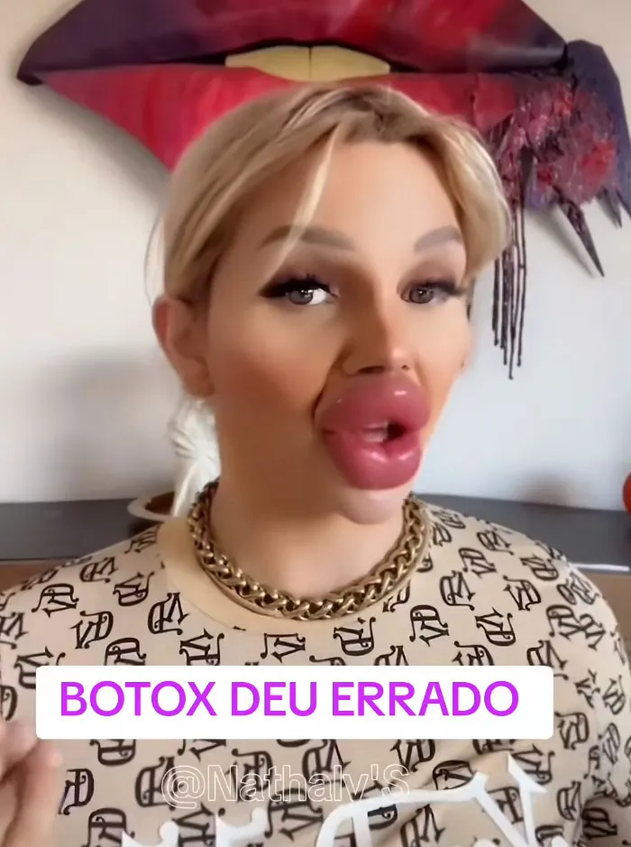 Woman with extremely swollen overfilled lips as one of beauty procedures fails