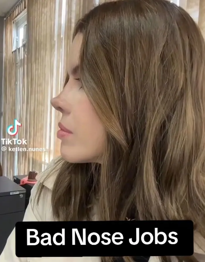 Side profile of a woman with an unnatural turned up nose showing bad nose job beauty procedures fails.