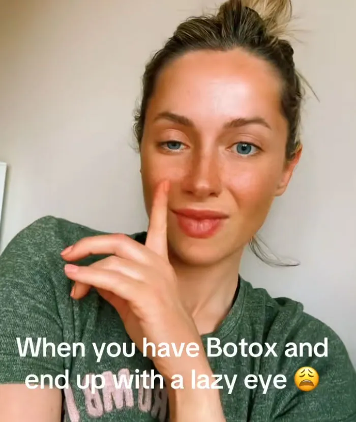 A woman with a drooping eyelid after receiving botox as an example of beauty procedures fails