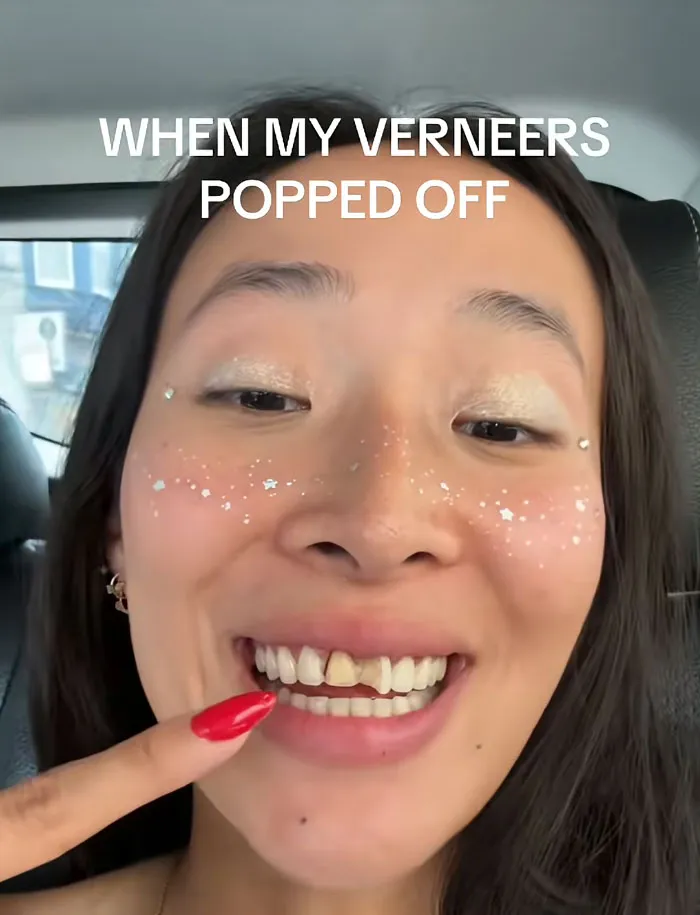 A woman pointing to a missing front dental veneer representing beauty procedures fails