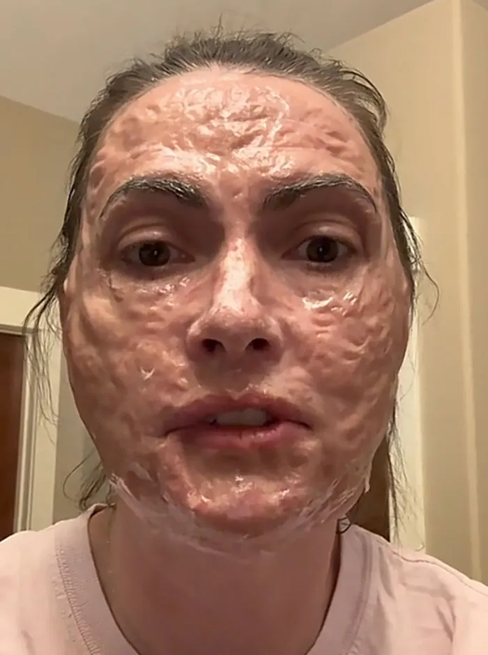 A woman with a textured peeling face mask showing the side effects of beauty procedures fails