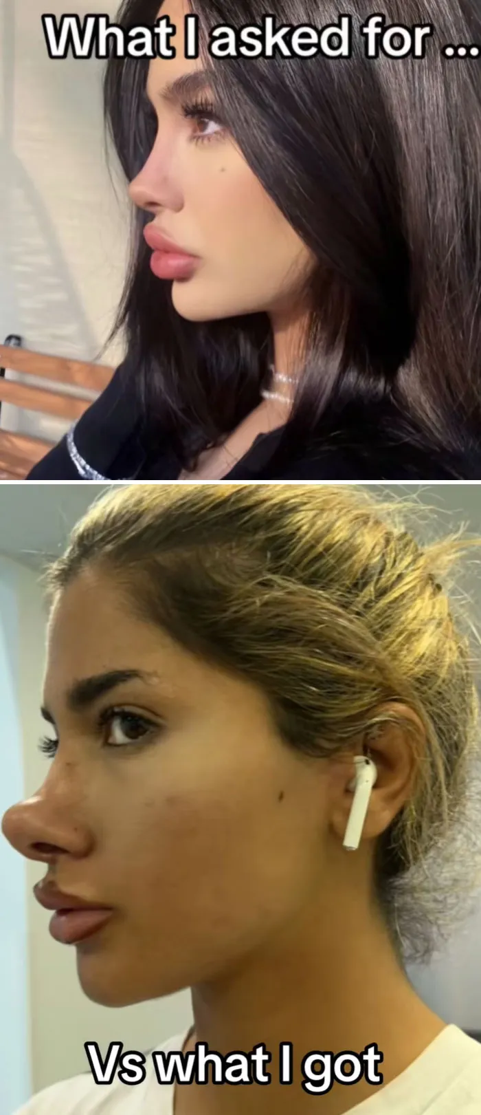 A comparison of a desired nose shape versus a botched nose job, showing beauty procedures fails