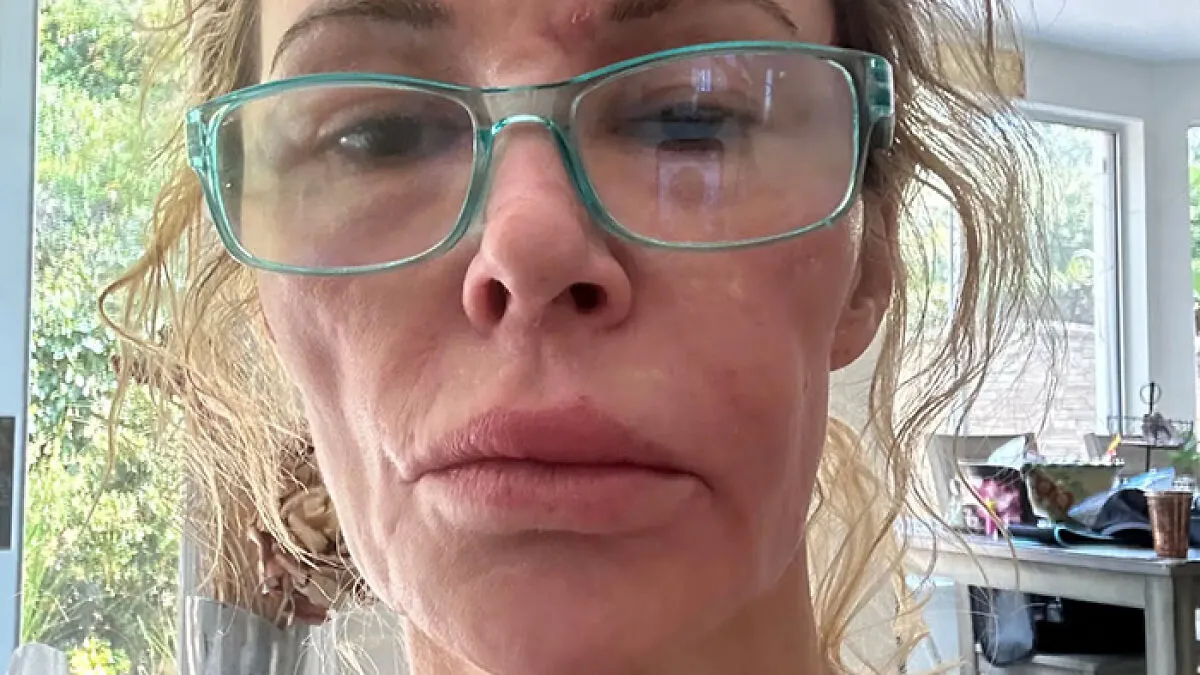 ‘Embarrassed’ Brandi Glanville Breaks Down Over Asking Fans For Money Amid Ongoing Facial Disfigurement