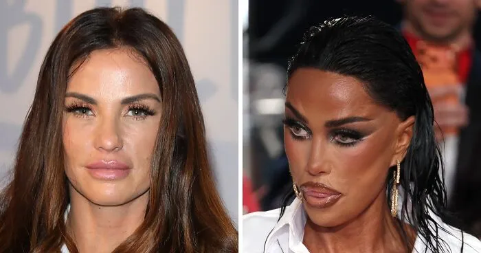Katie Price Sparks Concern With Latest Appearance After Having Corrective Surgery
