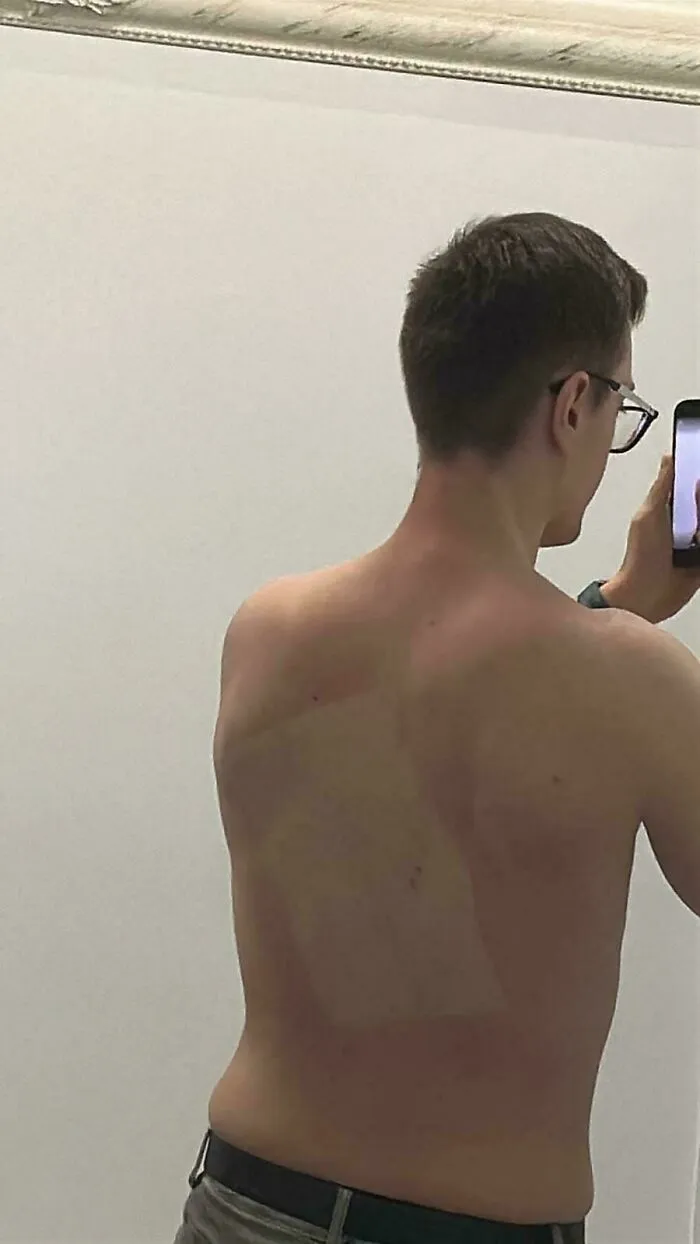 A man with a rectangular sunburn patch on his back demonstrating how things went wrong with sunscreen application