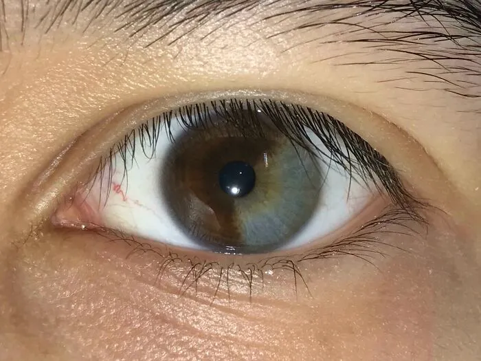 Close-up of human anatomy showing a unique eye with sectoral heterochromia divided into brown and hazel shades.