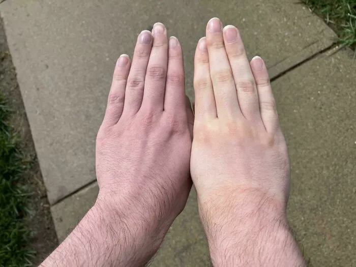 Human anatomy photo showing two hands with different skin tones side-by-side