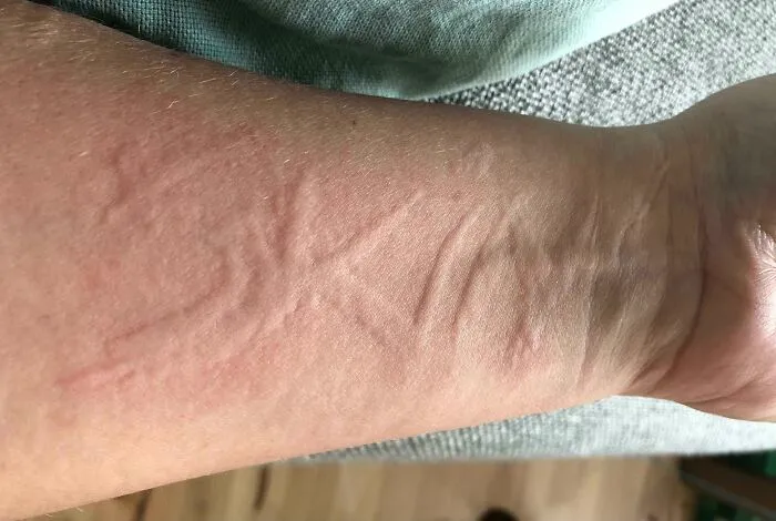 Dermatographia condition causing raised skin markings on a forearm, displaying unique human anatomy.