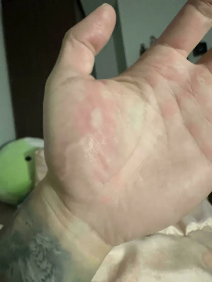 An open palm showing an unusual white patch as a unique human anatomy body feature