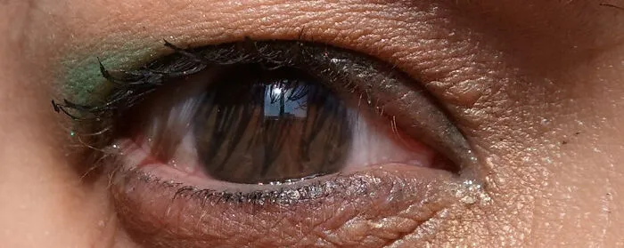 Close up of an eye showing persistent pupillary membrane, an uncommon human anatomy trait.