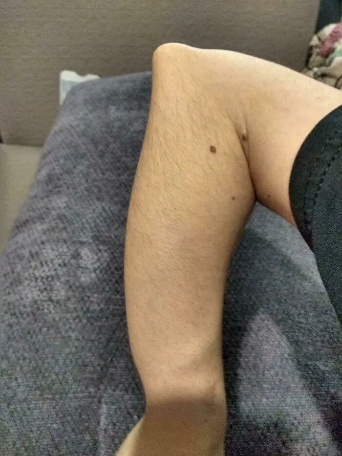 Unique human anatomy showing an unusually sharp or prominent elbow joint bend resting on a armrest.