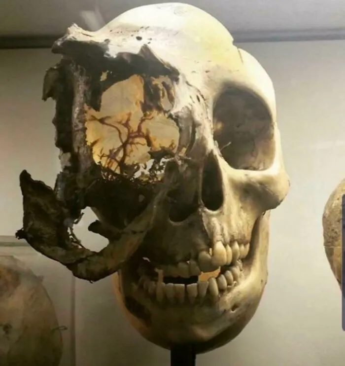 Historical human anatomy exhibit displaying a severely damaged skull with a large side fracture.