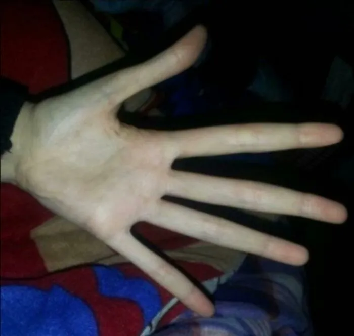 Unusual human anatomy of an elongated hand with exceptionally long fingers spread out flat.