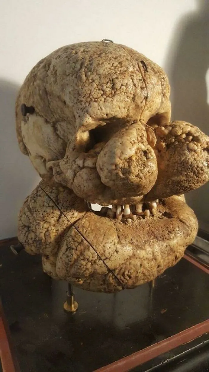 A skull model displaying unusual human anatomy and bone growth features.