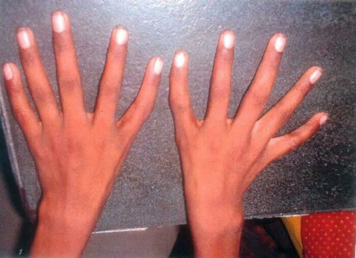 Triphalangeal Thumb Syndrome