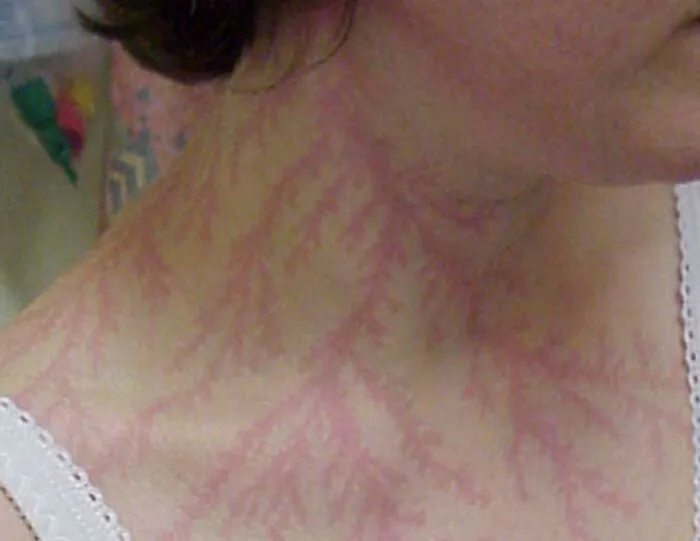 Lichtenberg figure mark on skin showing unique human anatomy feature from lightning strike.