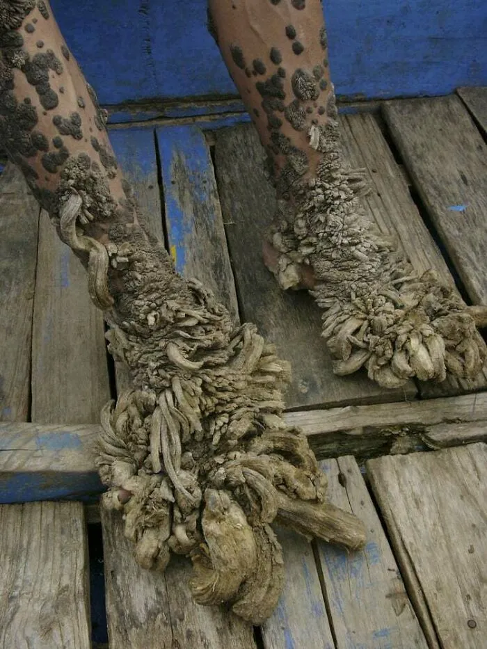 Severe skin lesions on legs and feet demonstrating a rare human anatomy feature.