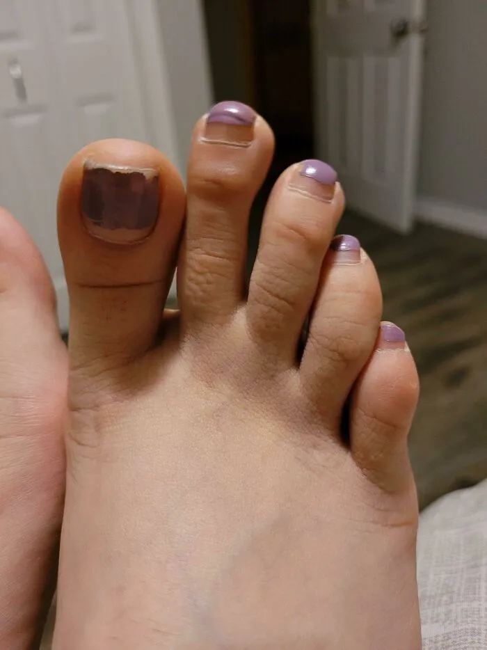 Close-up of a foot with purple nail polish displaying a unique toe alignment as an example of human anatomy features.
