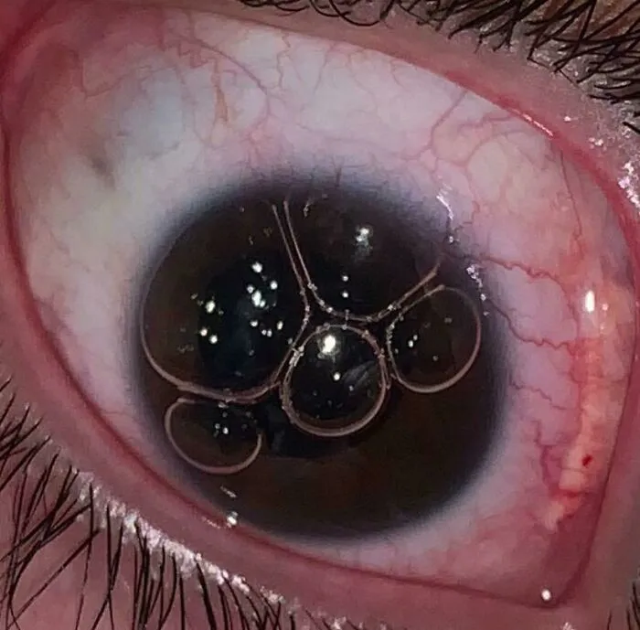 Close-up of a human eye with air bubbles under a lens demonstrating unusual human anatomy features