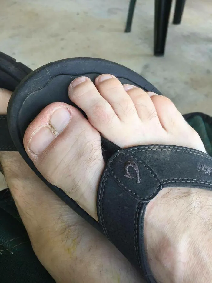 Close-up of a foot wearing a sandal highlighting unique human anatomy features