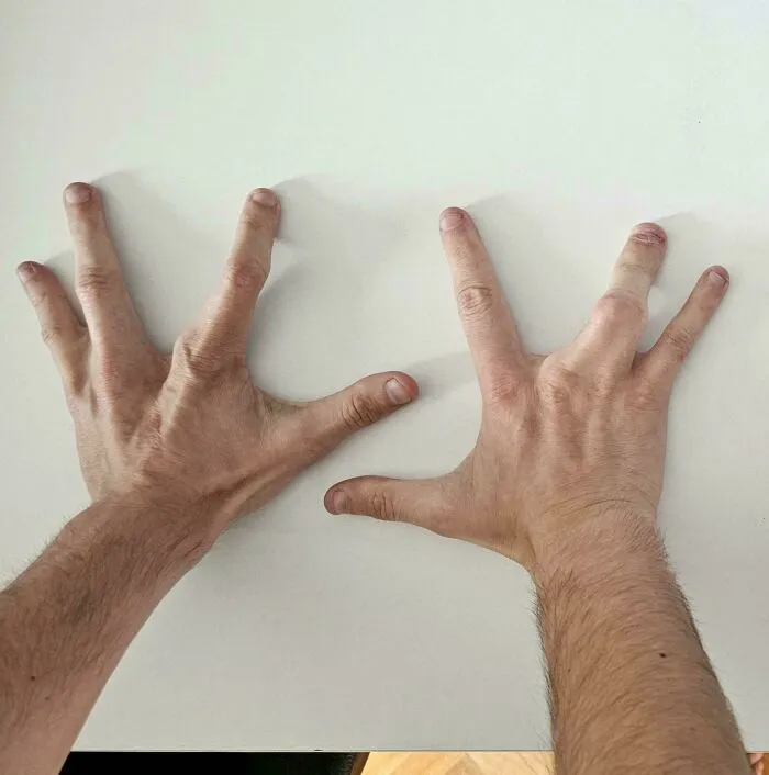 Unique human anatomy featuring hands with an unusual arrangement of digits.