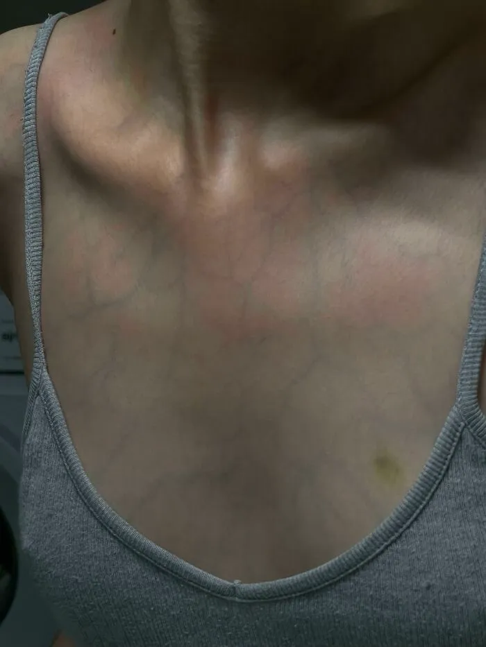 Human anatomy showing visible blue veins running across a person's chest area.
