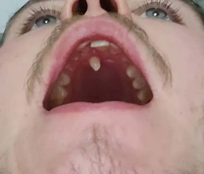 Close-up view of unusual human anatomy showing an extra tooth growing on the roof of a person's mouth