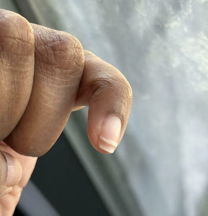 My Nail Split, Now I Have Two Little Nail Tips