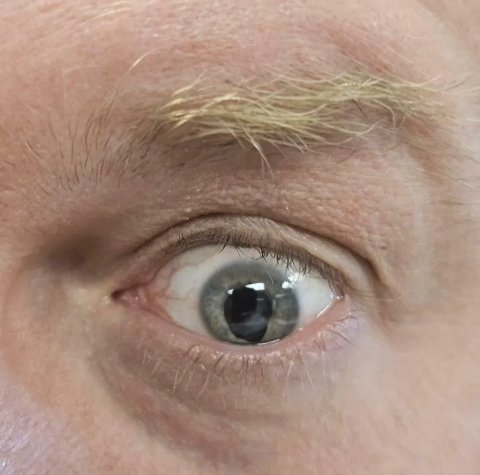 Close-up of human anatomy revealing an unusually shaped keyhole pupil in an eye