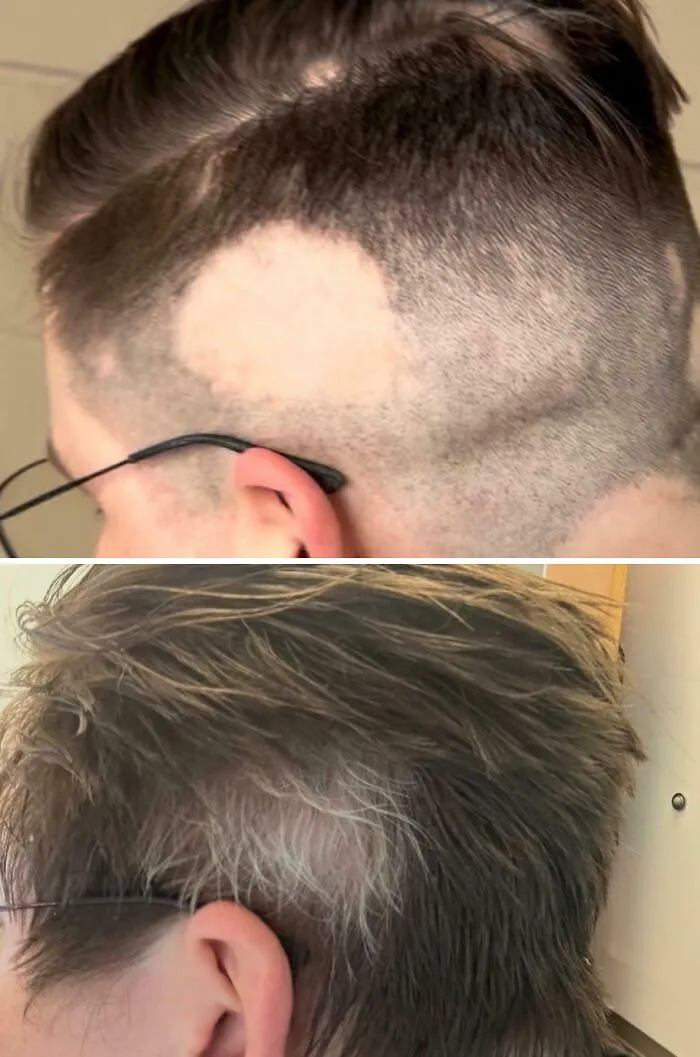 Before and after images of human anatomy showing hair regrowing white over a bald patch feature.