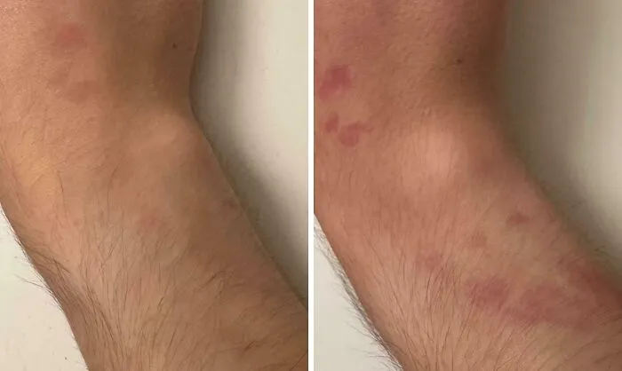 Side-by-side comparison of human anatomy showing skin red spots appearing after exercise