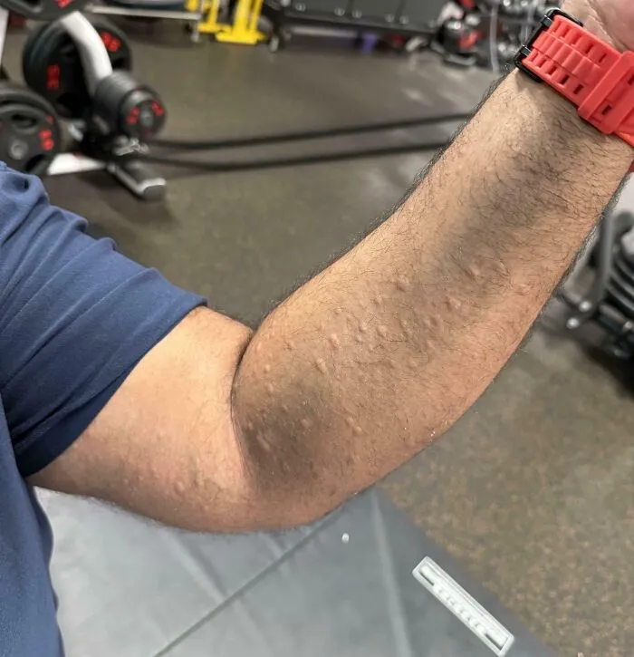 Hives and bumps on a man arm showcasing a skin reaction in human anatomy.
