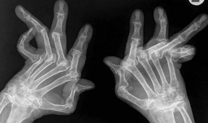 X-ray image showing hand bones with severe joint deformity in human anatomy.