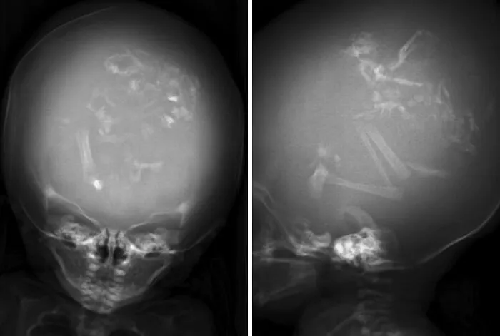 An X-ray scan displaying rare human anatomy features with medical imaging of a skull