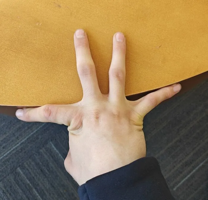 An unusual hand structure displaying interesting human anatomy with widely spread fingers on a desk.