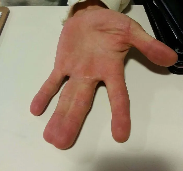 A hand showing a unique feature of human anatomy with four fingers resting flat on a white surface.