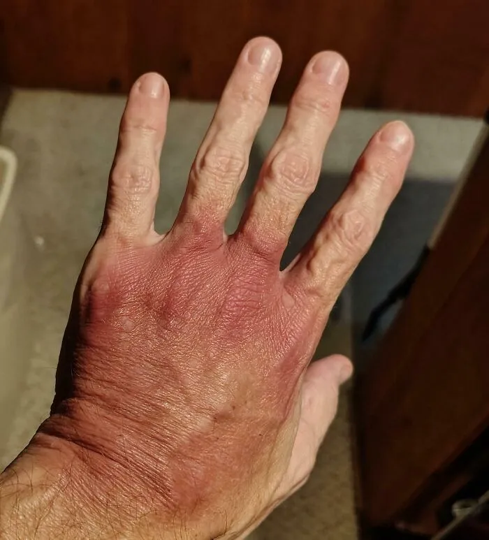 A hand showing severe redness from Raynauds phenomenon, a unique condition in human anatomy.