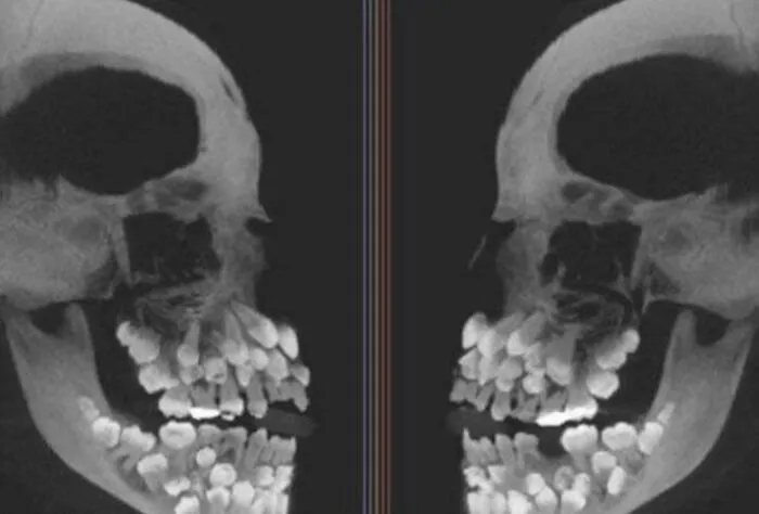 Medical X-ray scan of a human anatomy skull showing extreme hyperdontia with numerous extra teeth in the jaw.