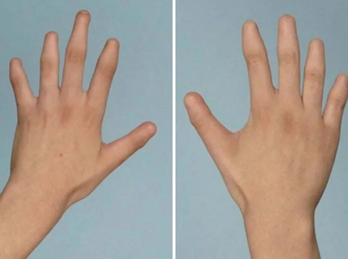 Hands with polydactyly showing extra fingers as a unique human anatomy feature.