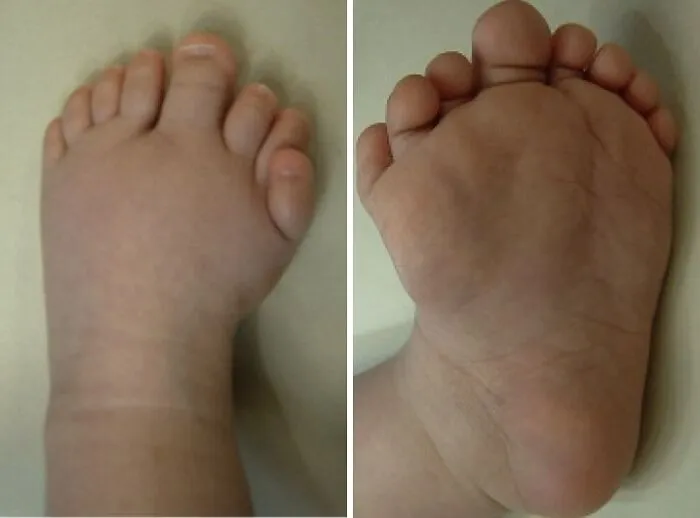 A human anatomy feature showing a foot with six toes on a baby.