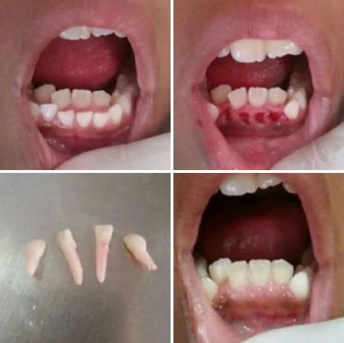 Dental procedure showing extracted extra teeth, an unusual human anatomy feature.