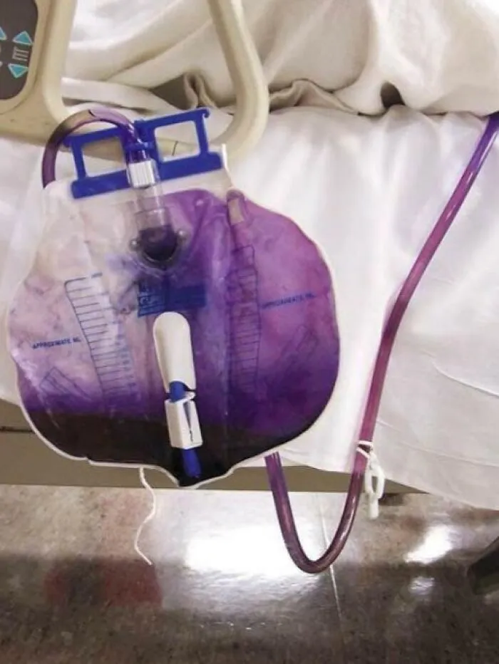 Medical catheter bag displaying purple urine, an unusual rare body feature caused by a reaction.