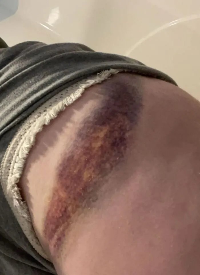 Medical photos of a large dark purple bruise across a person's waist and hip.