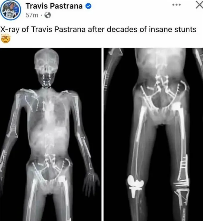 Full body X-rays showing surgical pins and implants from injuries, featured in disturbing medical photos.