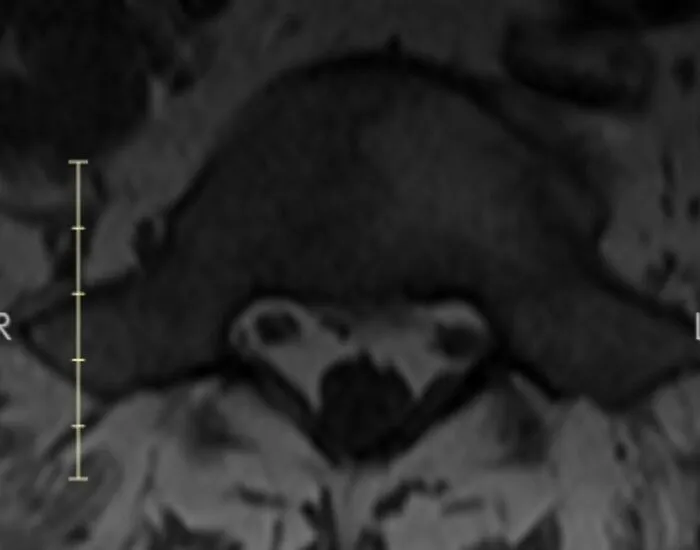 An axial spinal MRI scan showing vertebrae and soft tissue, shared in disturbing medical photos.