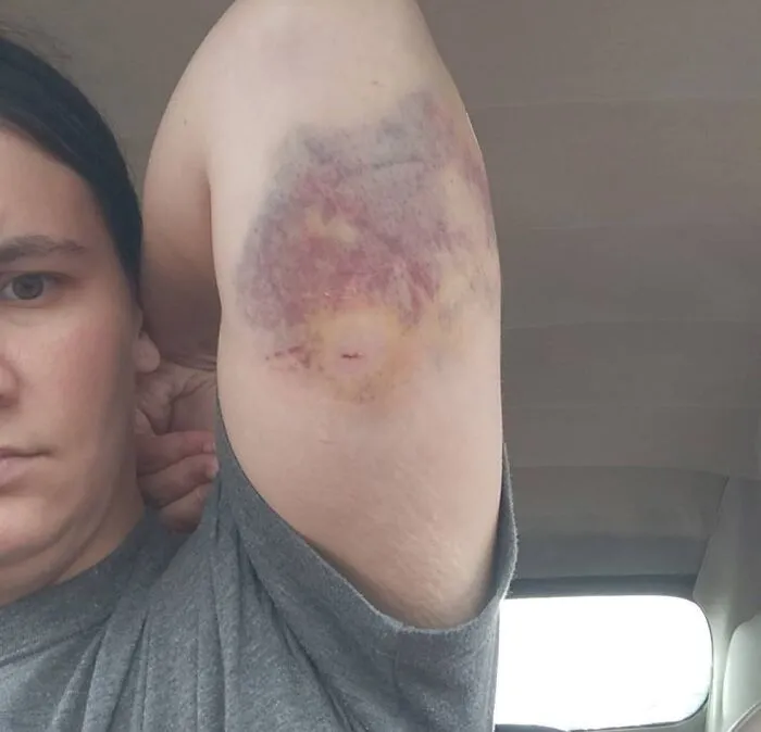 Disturbing medical photo showing a severe purple and yellow bruise on an inner arm after blood donation