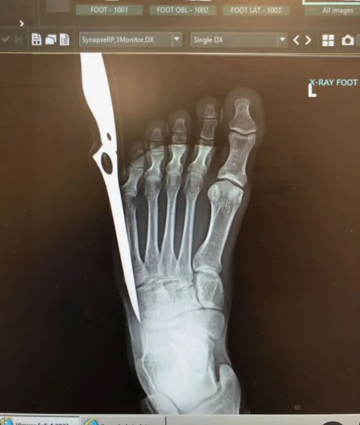 Medical photo showing an X-ray of a human foot with a long knife blade embedded along the side